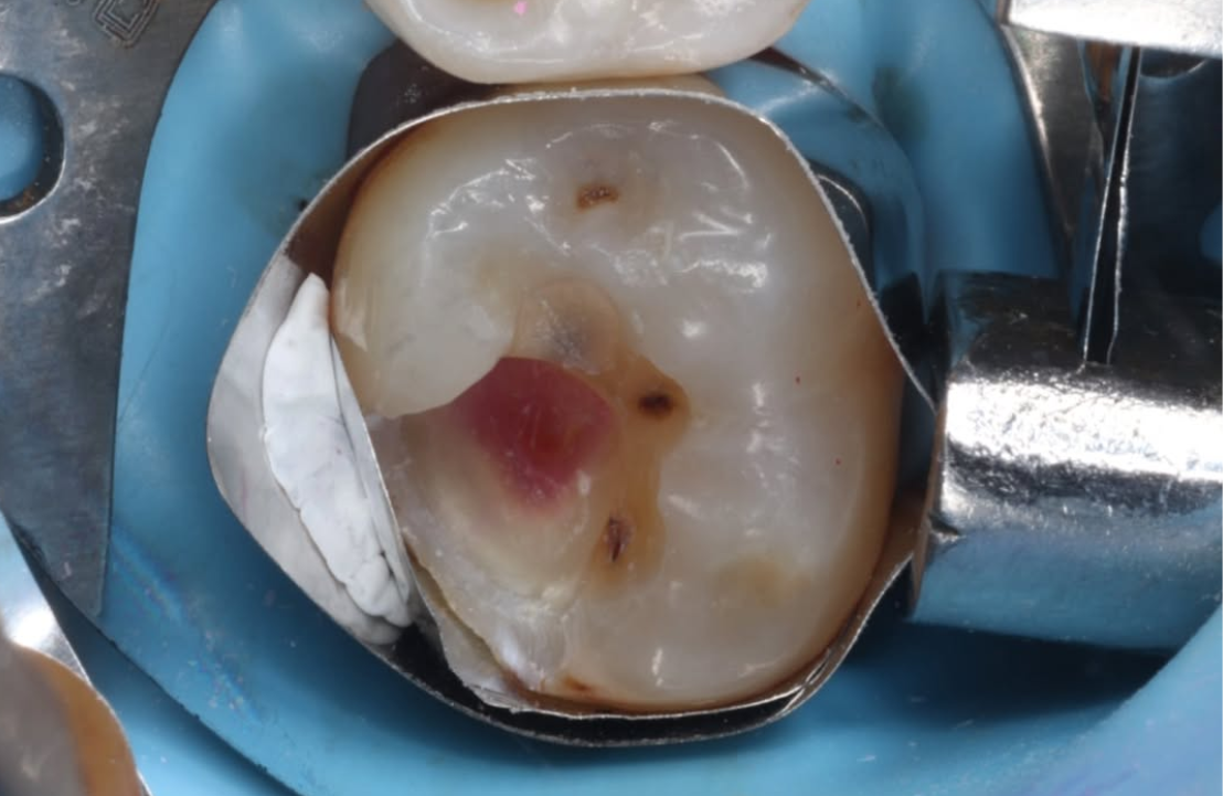 Composite restoration before