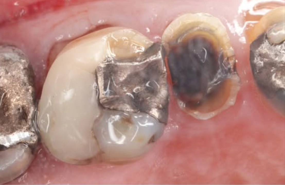 Double emax onlay before photo