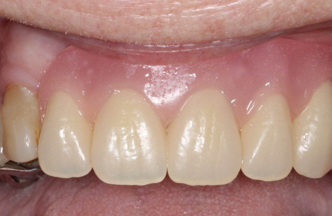 After new denture photo