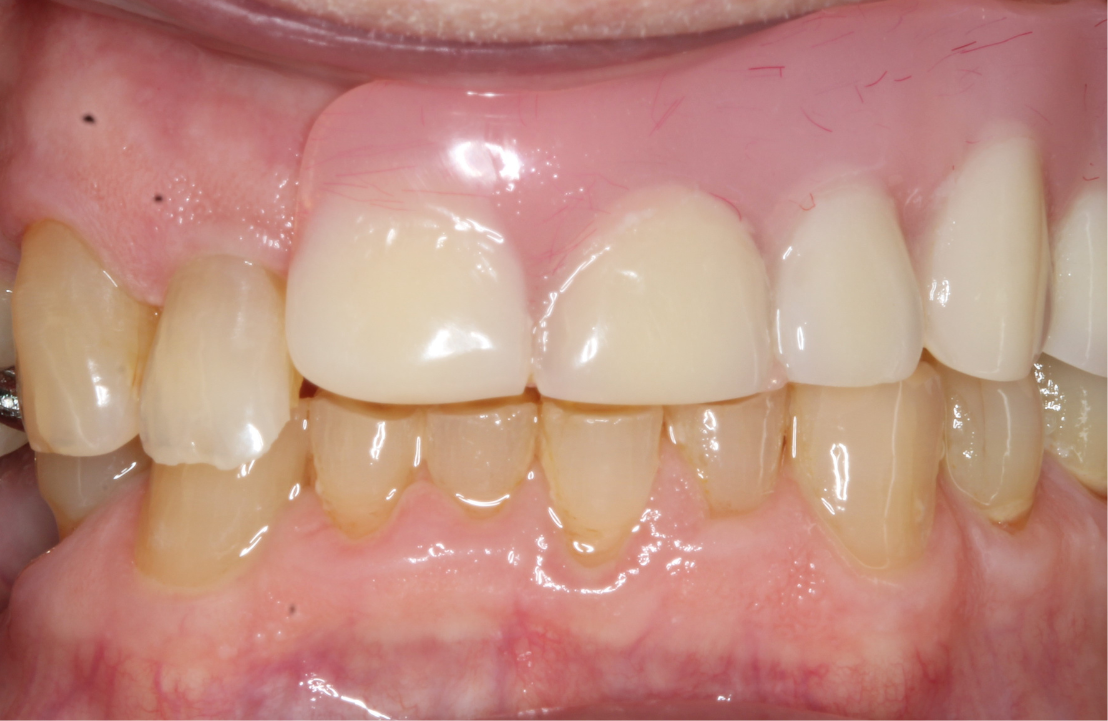 Before new denture photo