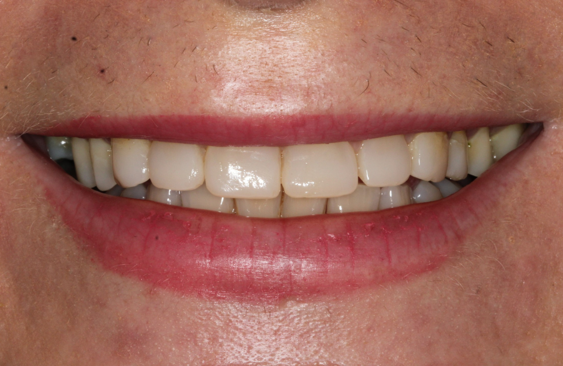 Compositing bonding after photo