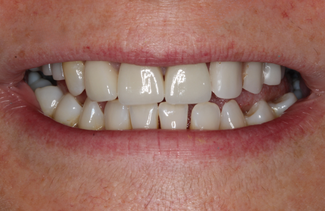 After denture by Dr Dimple Patel