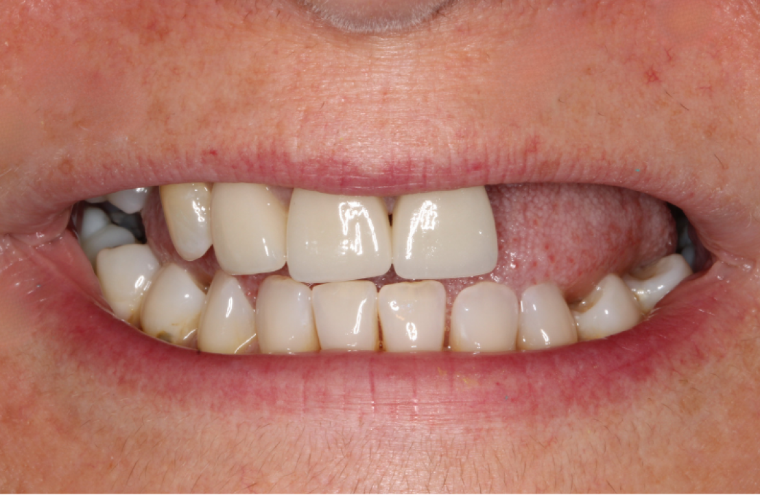 Before Denture by Dr Dimple Patel